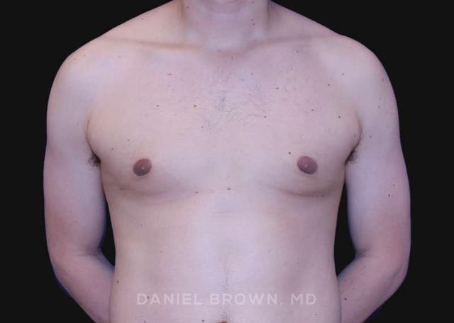 Breast Reduction after at Top Plastic Surgeon San Diego: Dr. Daniel Brown in San Diego, CA