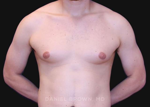 Breast Reduction before at Top Plastic Surgeon San Diego: Dr. Daniel Brown in San Diego, CA