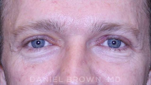 Blepharoplasty after at Top Plastic Surgeon San Diego: Dr. Daniel Brown in San Diego, CA