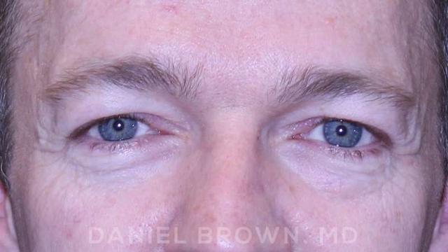 Blepharoplasty before at Top Plastic Surgeon San Diego: Dr. Daniel Brown in San Diego, CA