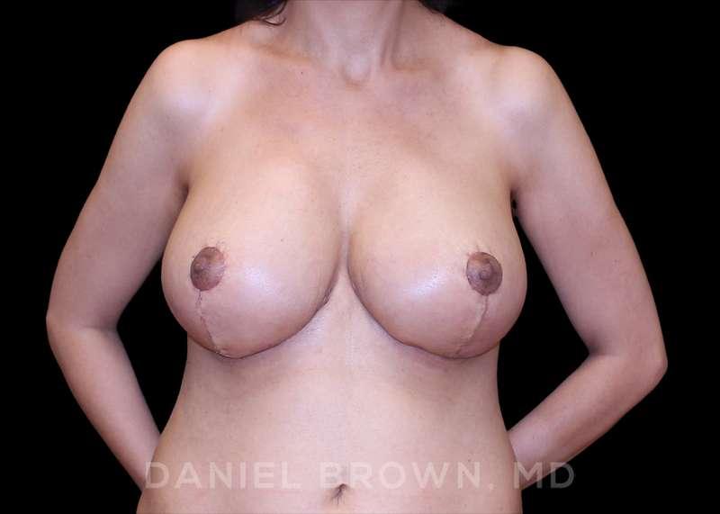 Top Plastic Surgeon San Diego: Dr. Daniel Brown breast reduction after — San Diego, CA