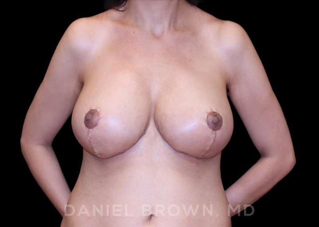 Breast Reduction after at Top Plastic Surgeon San Diego: Dr. Daniel Brown in San Diego, CA