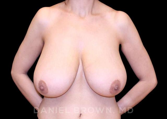 Breast Reduction before at Top Plastic Surgeon San Diego: Dr. Daniel Brown in San Diego, CA