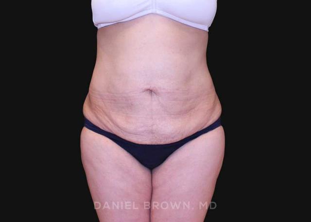Tummy Tuck before at Top Plastic Surgeon San Diego: Dr. Daniel Brown in San Diego, CA