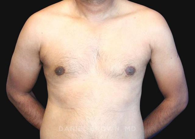 Gynecomastia Surgery after at Top Plastic Surgeon San Diego: Dr. Daniel Brown in San Diego, CA