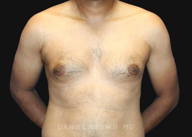 Gynecomastia Surgery before at Top Plastic Surgeon San Diego: Dr. Daniel Brown in San Diego, CA