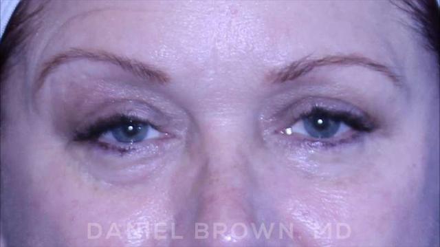 Blepharoplasty after at Top Plastic Surgeon San Diego: Dr. Daniel Brown in San Diego, CA