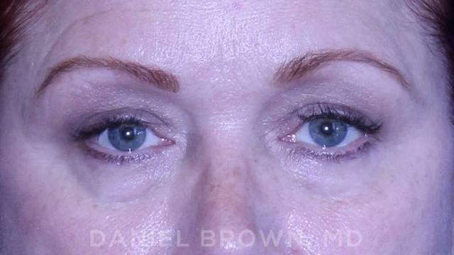 Blepharoplasty before at Top Plastic Surgeon San Diego: Dr. Daniel Brown in San Diego, CA