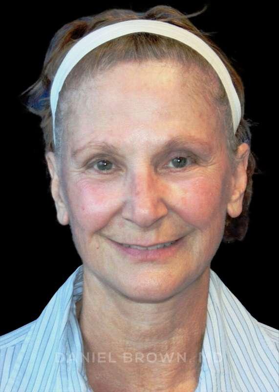 Top Plastic Surgeon San Diego: Dr. Daniel Brown facelift after — San Diego, CA