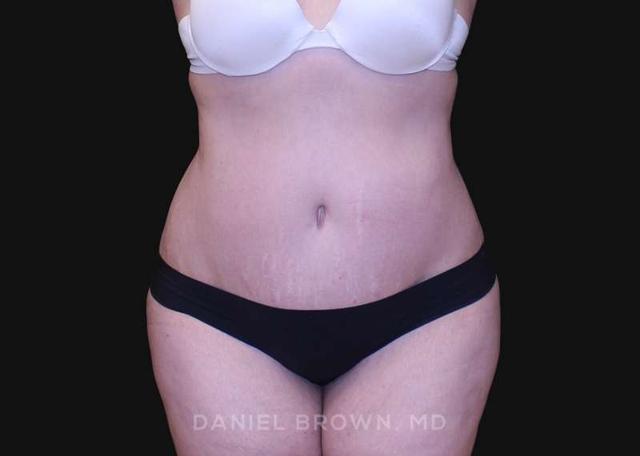 Tummy Tuck after at Top Plastic Surgeon San Diego: Dr. Daniel Brown in San Diego, CA