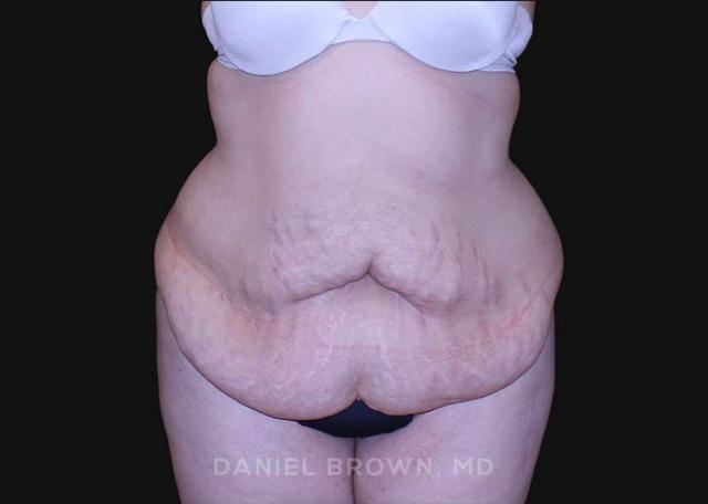 Tummy Tuck before at Top Plastic Surgeon San Diego: Dr. Daniel Brown in San Diego, CA