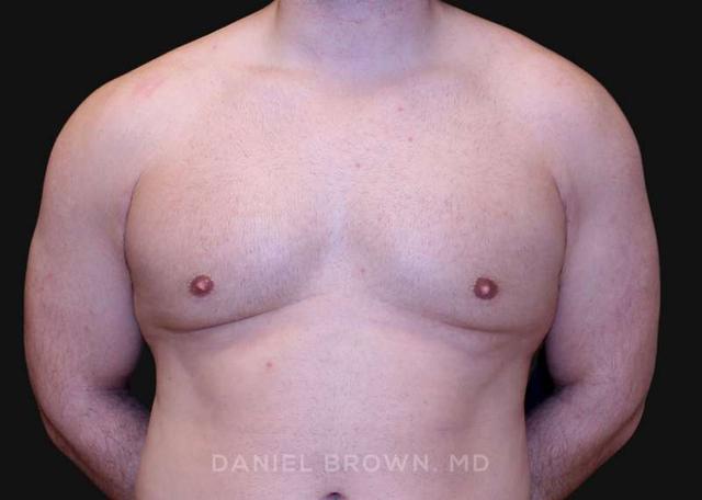 Gynecomastia Surgery after at Top Plastic Surgeon San Diego: Dr. Daniel Brown in San Diego, CA