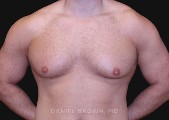 Gynecomastia Surgery before at Top Plastic Surgeon San Diego: Dr. Daniel Brown in San Diego, CA