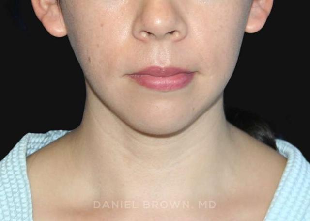 Neck Liposuction after at Top Plastic Surgeon San Diego: Dr. Daniel Brown in San Diego, CA