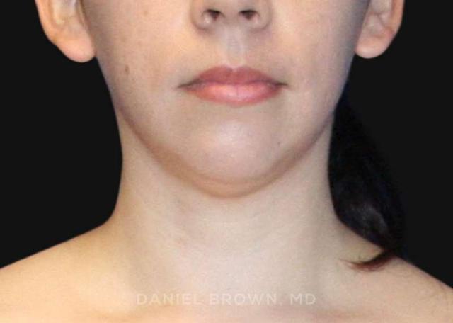 Neck Liposuction before at Top Plastic Surgeon San Diego: Dr. Daniel Brown in San Diego, CA