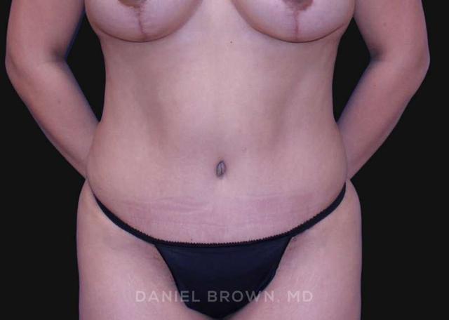 Mommy Makeover after at Top Plastic Surgeon San Diego: Dr. Daniel Brown in San Diego, CA