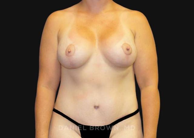 Tummy Tuck after at Top Plastic Surgeon San Diego: Dr. Daniel Brown in San Diego, CA
