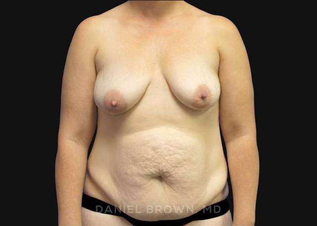 Tummy Tuck before at Top Plastic Surgeon San Diego: Dr. Daniel Brown in San Diego, CA