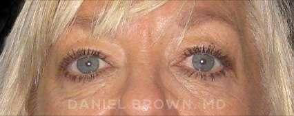 Blepharoplasty after at Top Plastic Surgeon San Diego: Dr. Daniel Brown in San Diego, CA