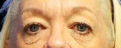 Blepharoplasty before at Top Plastic Surgeon San Diego: Dr. Daniel Brown in San Diego, CA