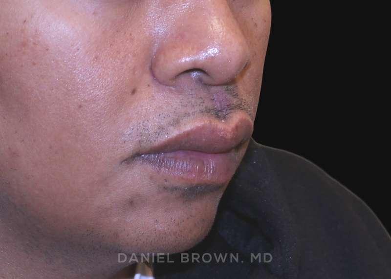 Top Plastic Surgeon San Diego: Dr. Daniel Brown after — San Diego, CA