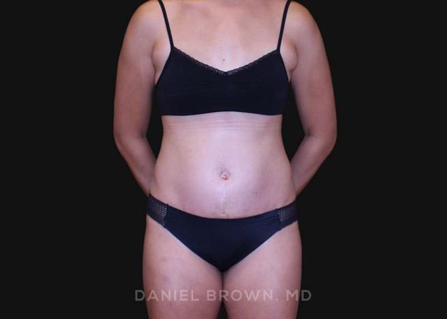 Tummy Tuck after at Top Plastic Surgeon San Diego: Dr. Daniel Brown in San Diego, CA