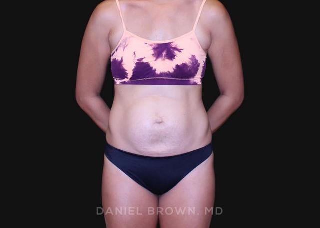 Tummy Tuck before at Top Plastic Surgeon San Diego: Dr. Daniel Brown in San Diego, CA