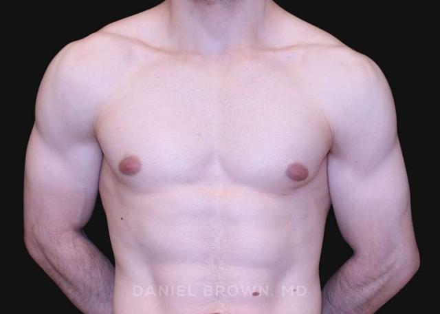Gynecomastia Surgery after at Top Plastic Surgeon San Diego: Dr. Daniel Brown in San Diego, CA