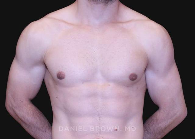 Gynecomastia Surgery before at Top Plastic Surgeon San Diego: Dr. Daniel Brown in San Diego, CA