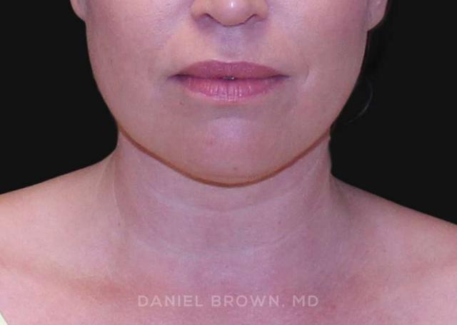 Neck Liposuction after at Top Plastic Surgeon San Diego: Dr. Daniel Brown in San Diego, CA