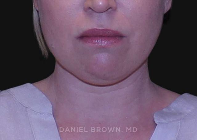 Neck Liposuction before at Top Plastic Surgeon San Diego: Dr. Daniel Brown in San Diego, CA