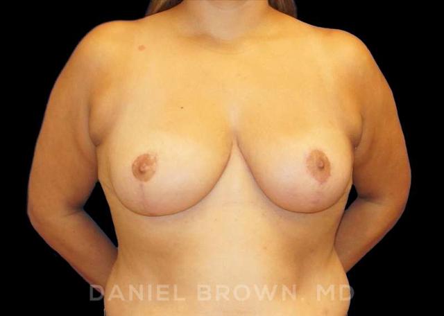 Breast Reduction after at Top Plastic Surgeon San Diego: Dr. Daniel Brown in San Diego, CA