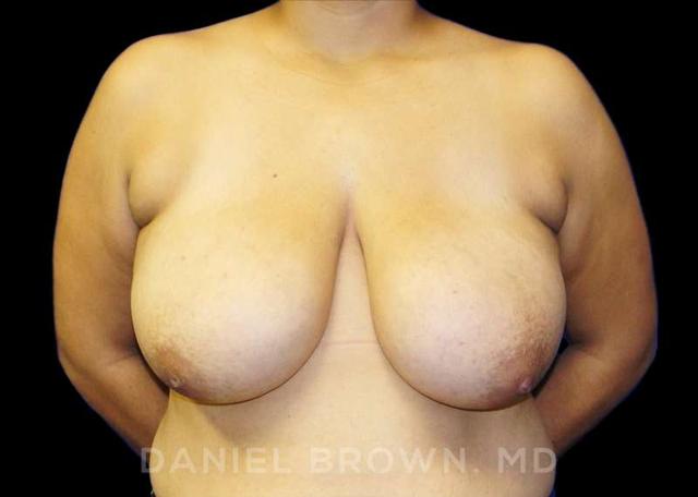 Breast Reduction before at Top Plastic Surgeon San Diego: Dr. Daniel Brown in San Diego, CA