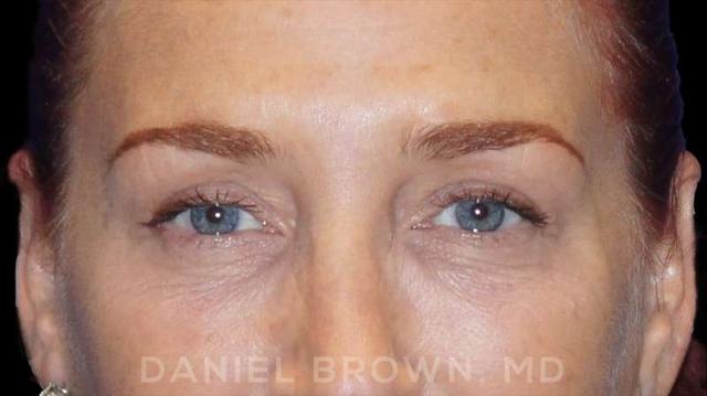 Blepharoplasty after at Top Plastic Surgeon San Diego: Dr. Daniel Brown in San Diego, CA