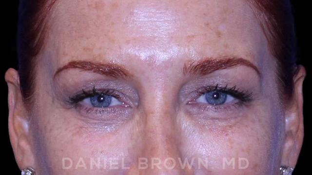 Blepharoplasty before at Top Plastic Surgeon San Diego: Dr. Daniel Brown in San Diego, CA