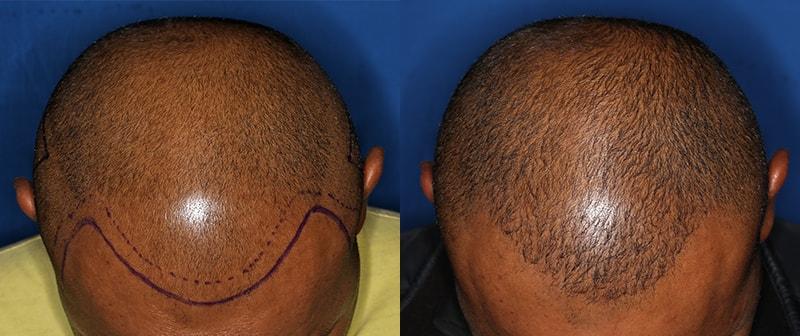 The Irvine Institute of Medicine & Cosmetic Surgery hair restoration result — Irvine, CA