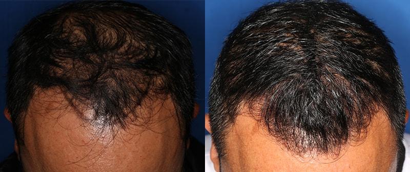 The Irvine Institute of Medicine & Cosmetic Surgery hair restoration result — Irvine, CA