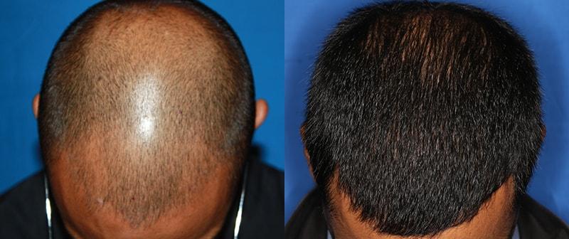 The Irvine Institute of Medicine & Cosmetic Surgery hair restoration result — Irvine, CA