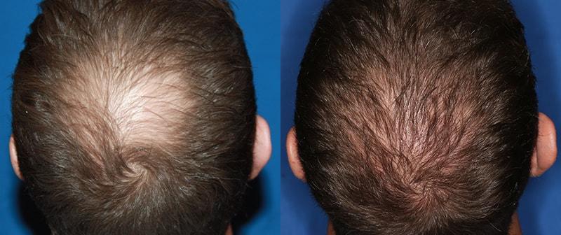 The Irvine Institute of Medicine & Cosmetic Surgery hair restoration result — Irvine, CA