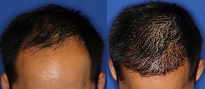 The Irvine Institute of Medicine & Cosmetic Surgery hair restoration result — Irvine, CA