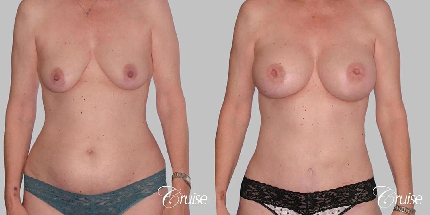 Cruise Plastic Surgery mommy makeover result — Newport Beach, CA