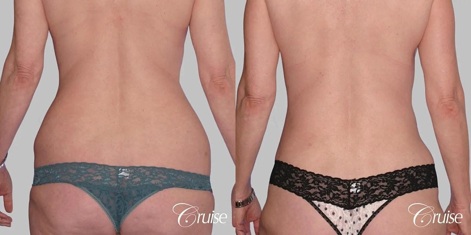 Cruise Plastic Surgery mommy makeover result — Newport Beach, CA