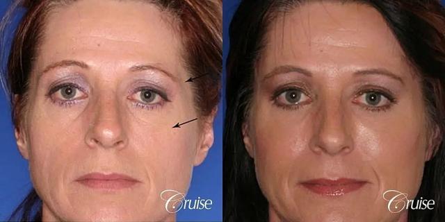Chemical Peel result at Cruise Plastic Surgery in Newport Beach, CA
