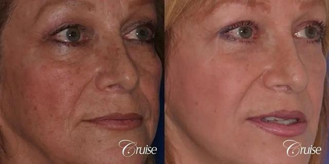 Chemical Peel result at Cruise Plastic Surgery in Newport Beach, CA