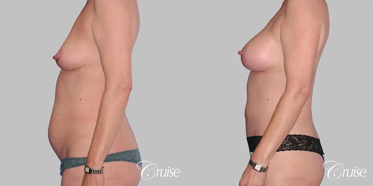 Cruise Plastic Surgery mommy makeover result — Newport Beach, CA