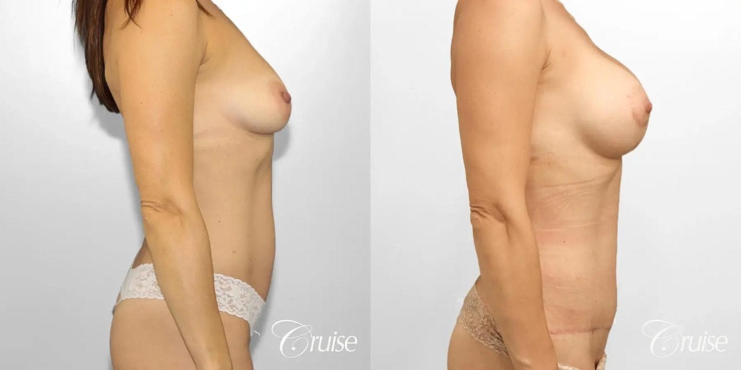 Cruise Plastic Surgery mommy makeover result — Newport Beach, CA
