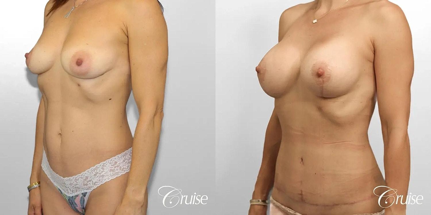 Cruise Plastic Surgery mommy makeover result — Newport Beach, CA