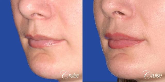 Lip Filler result at Cruise Plastic Surgery in Newport Beach, CA
