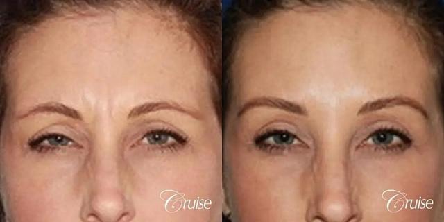 Botox result at Cruise Plastic Surgery in Newport Beach, CA
