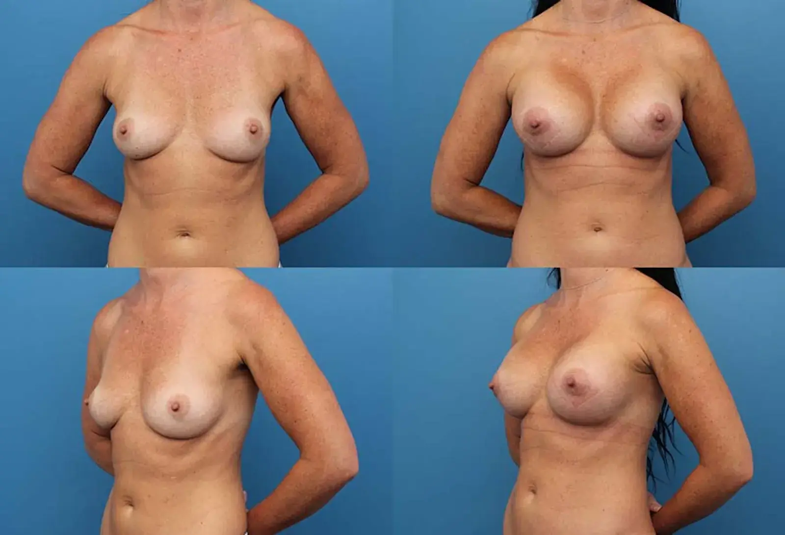 Ranch & Coast Plastic Surgery | Dr. Paul Chasan breast augmentation result — Del Mar, CA
